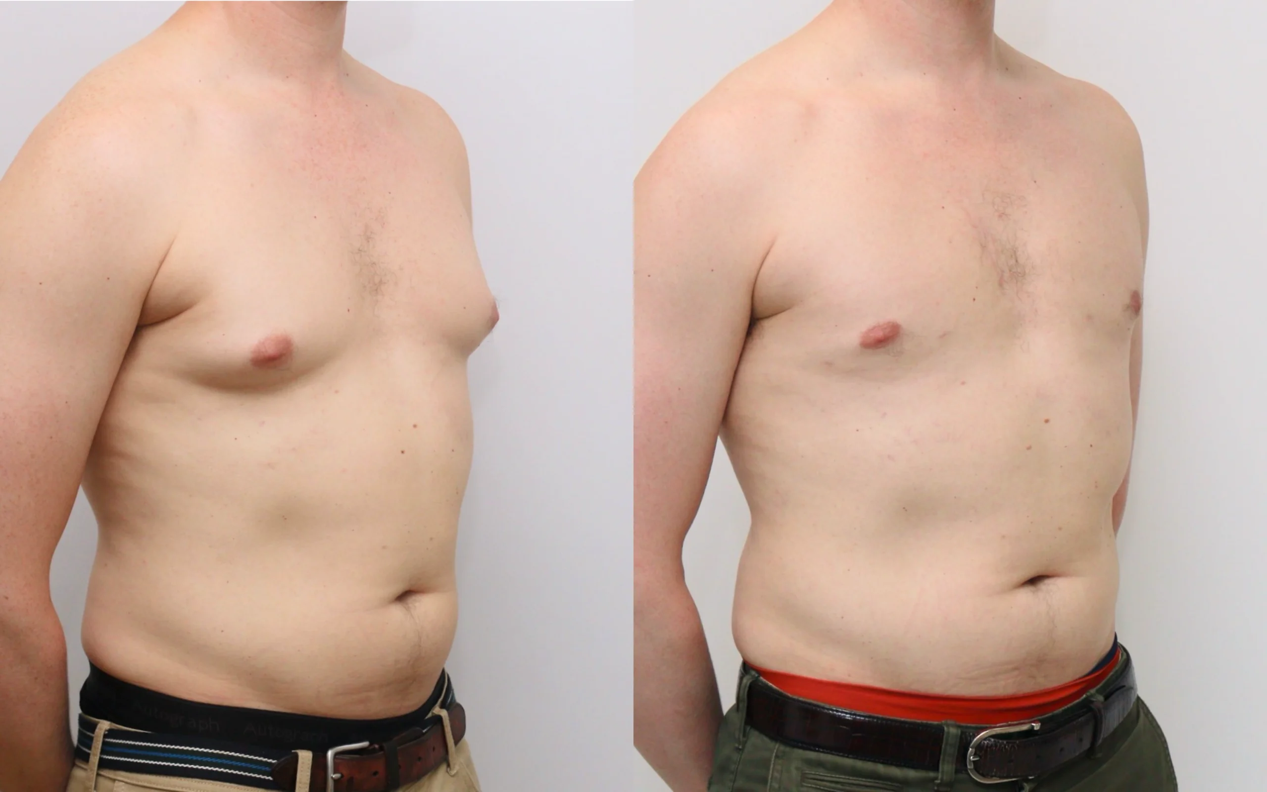 Gynecomastia liposuction result