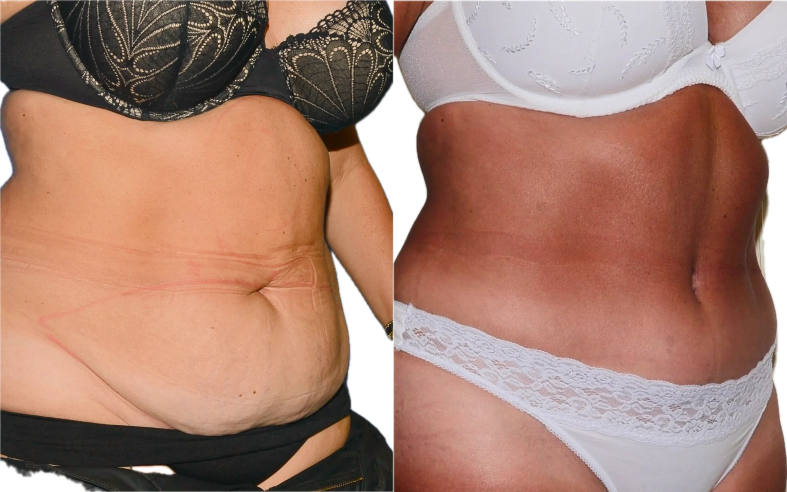 360 lipo and fully tummy tuck