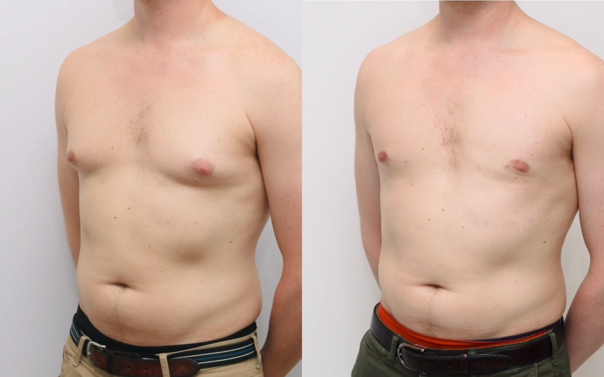 Gynecomastia liposuction result