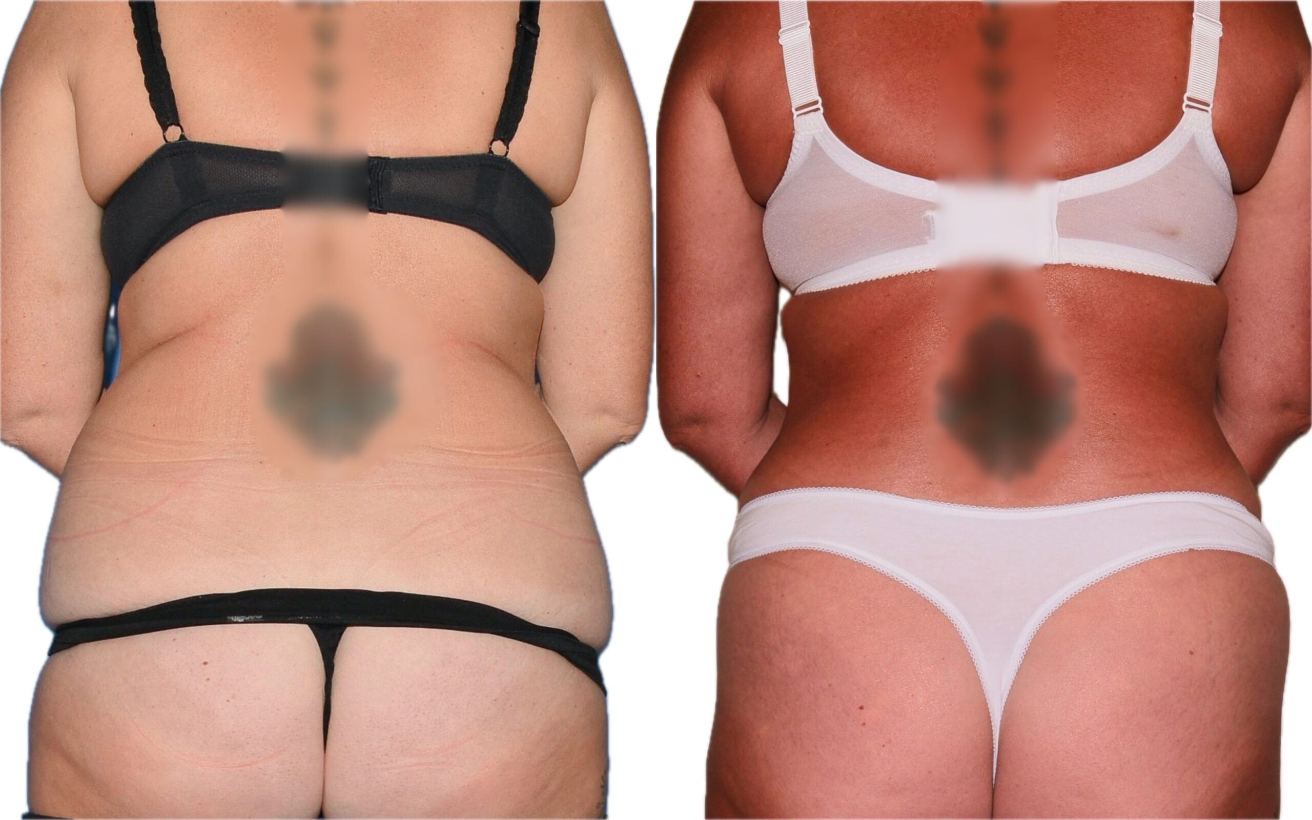 360 lipo and fully tummy tuck