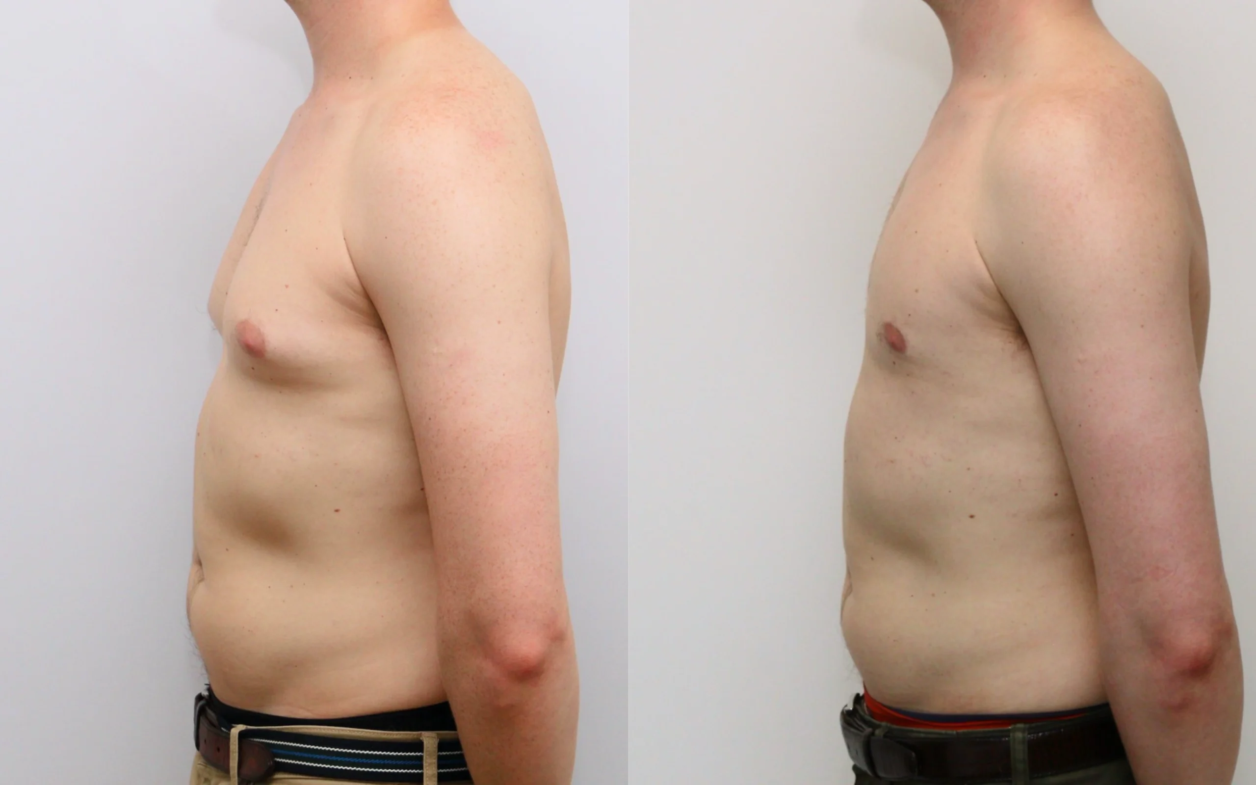 Gynecomastia liposuction result