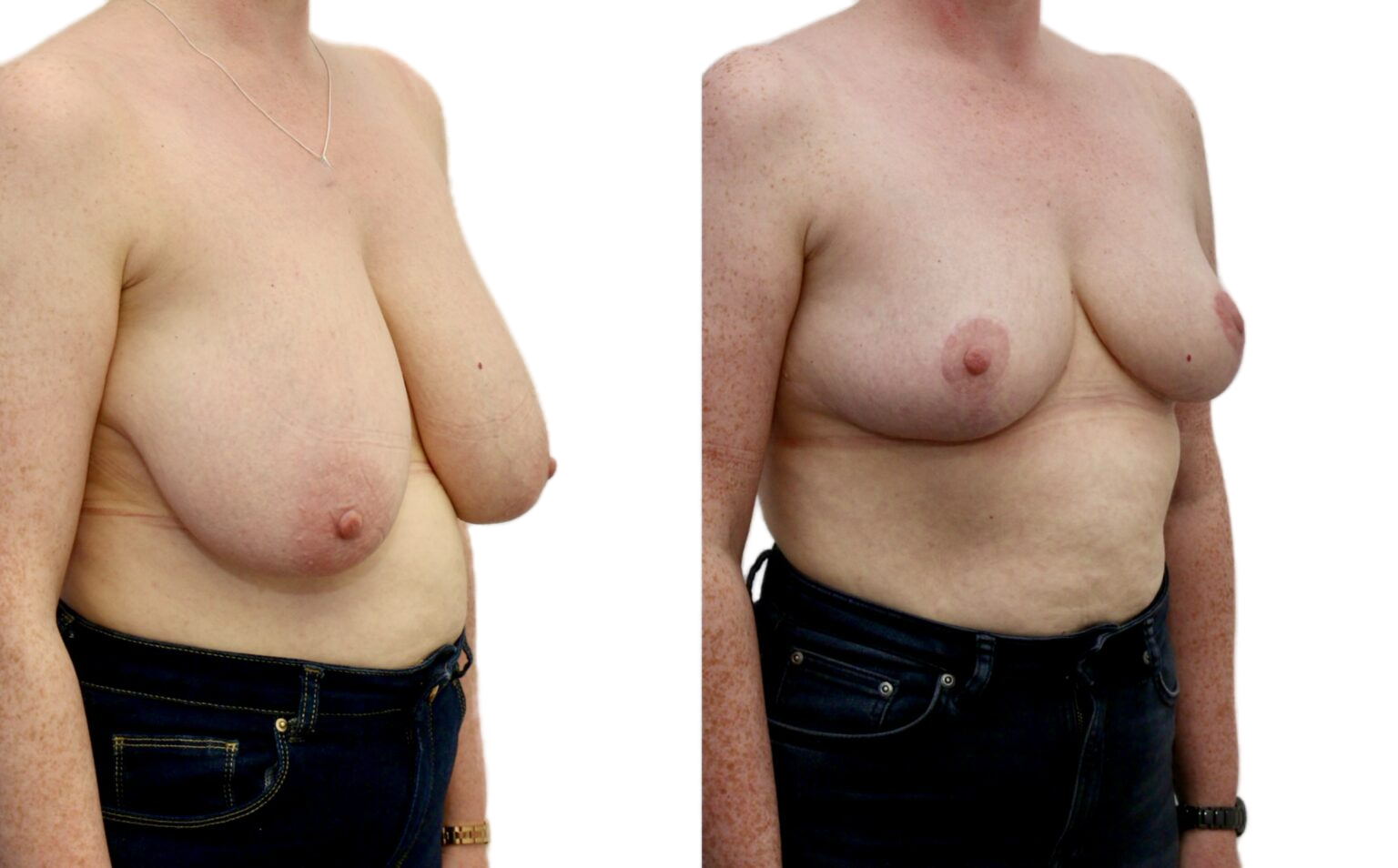 breast reduction before and after