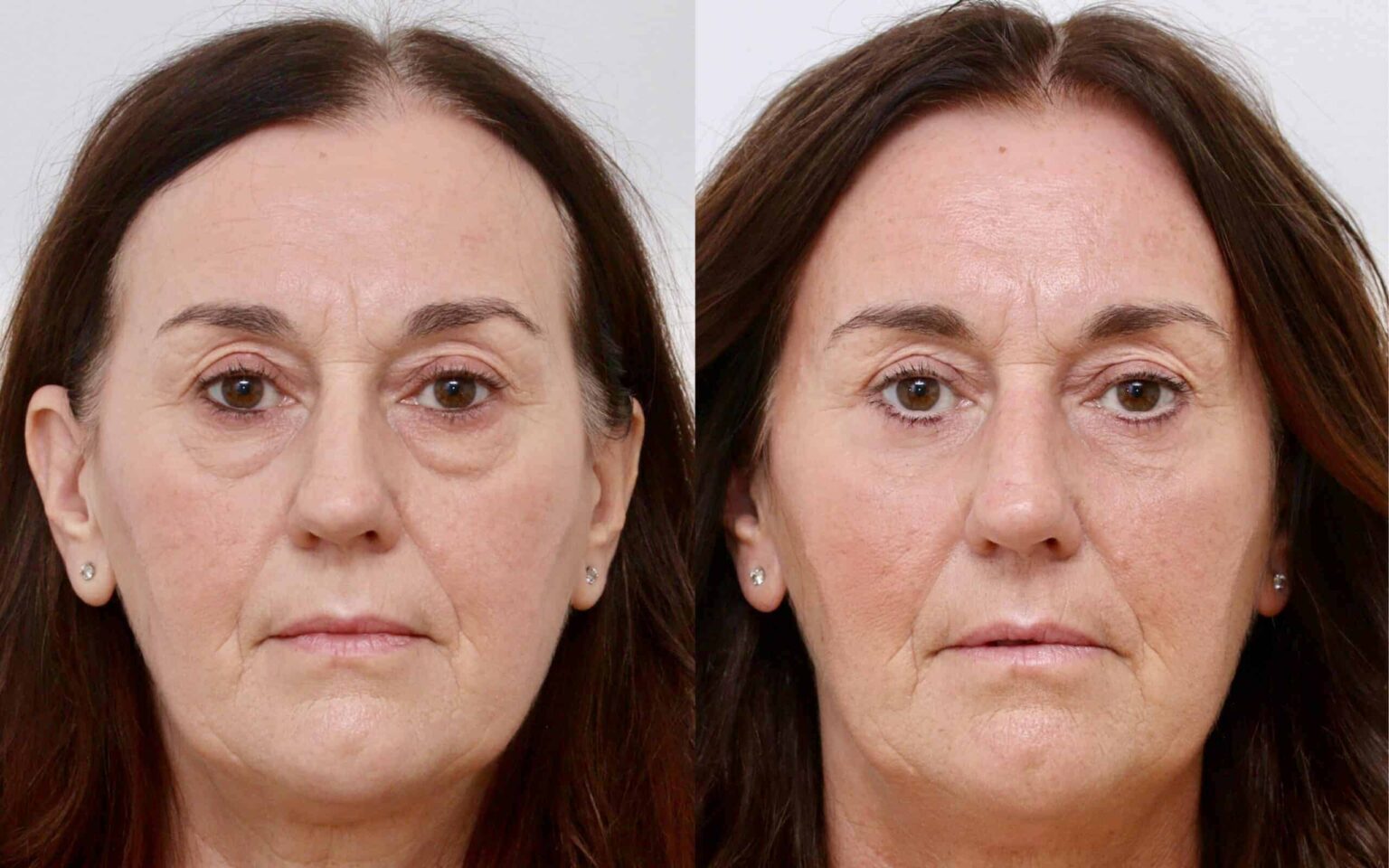 eyebag removal glasgow, blepharoplasty