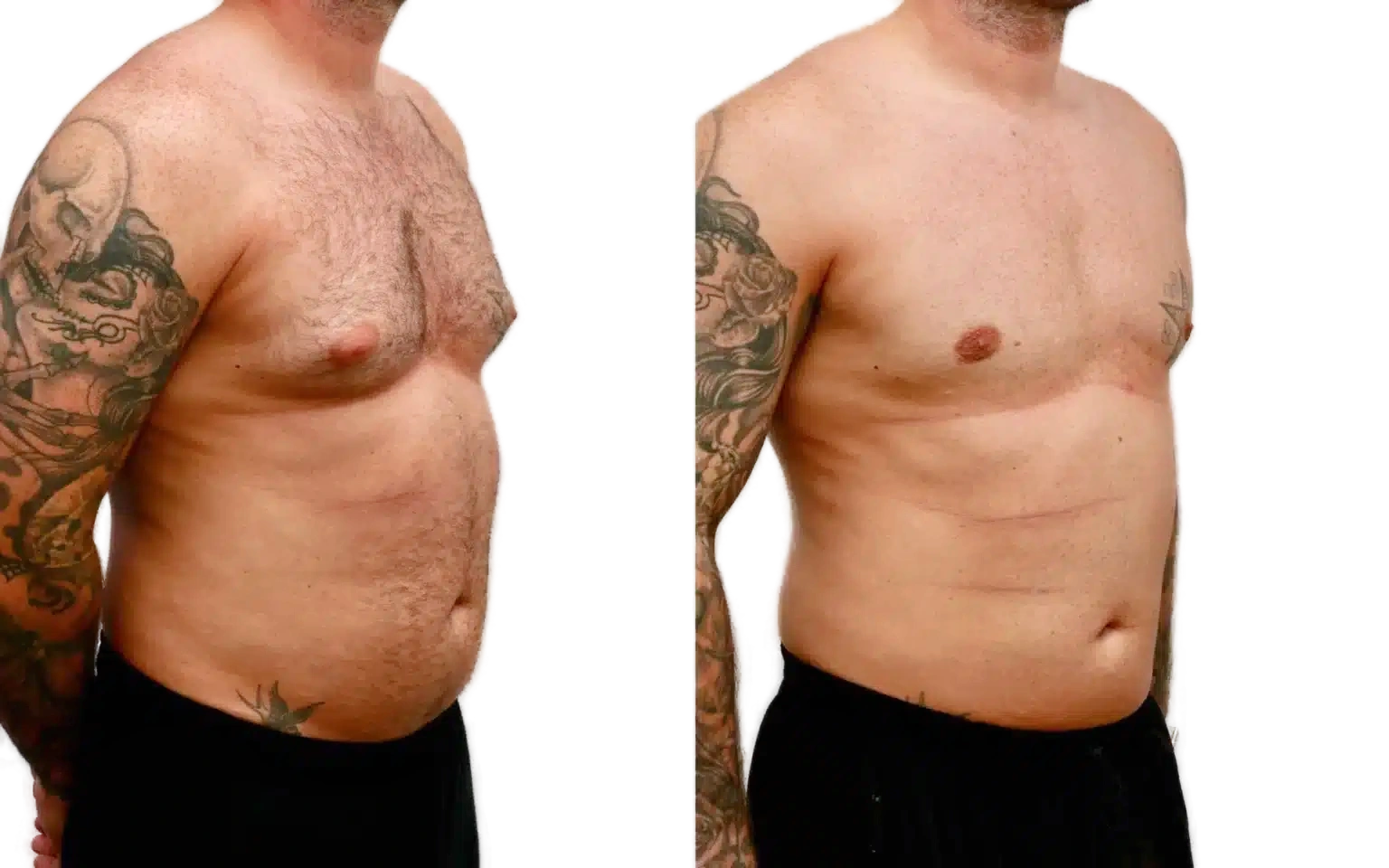 gynecomastia surgery edinburgh before and after