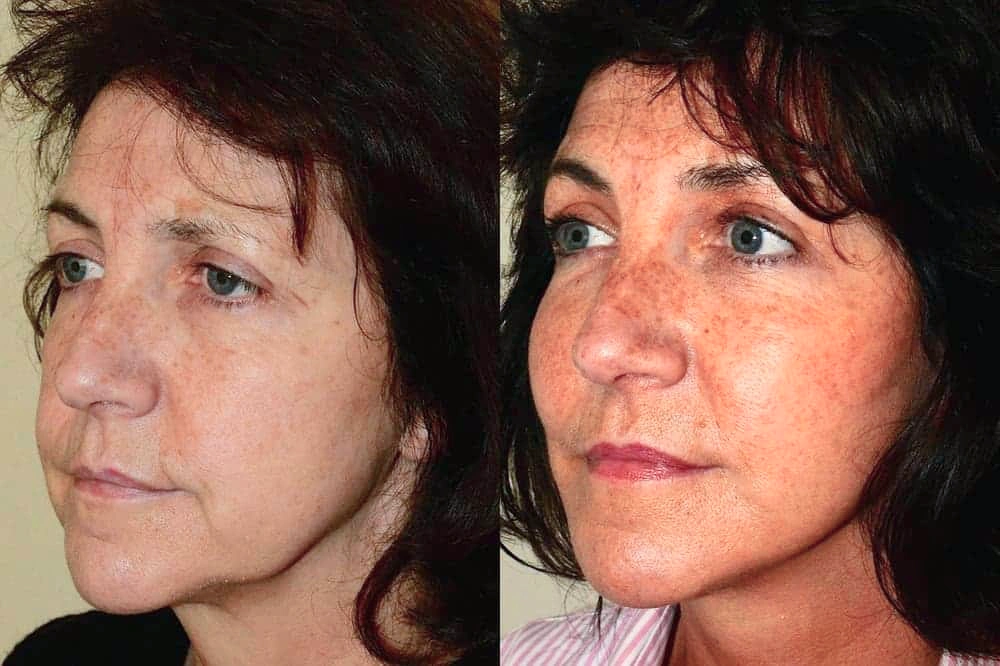 facelift surgery before and after