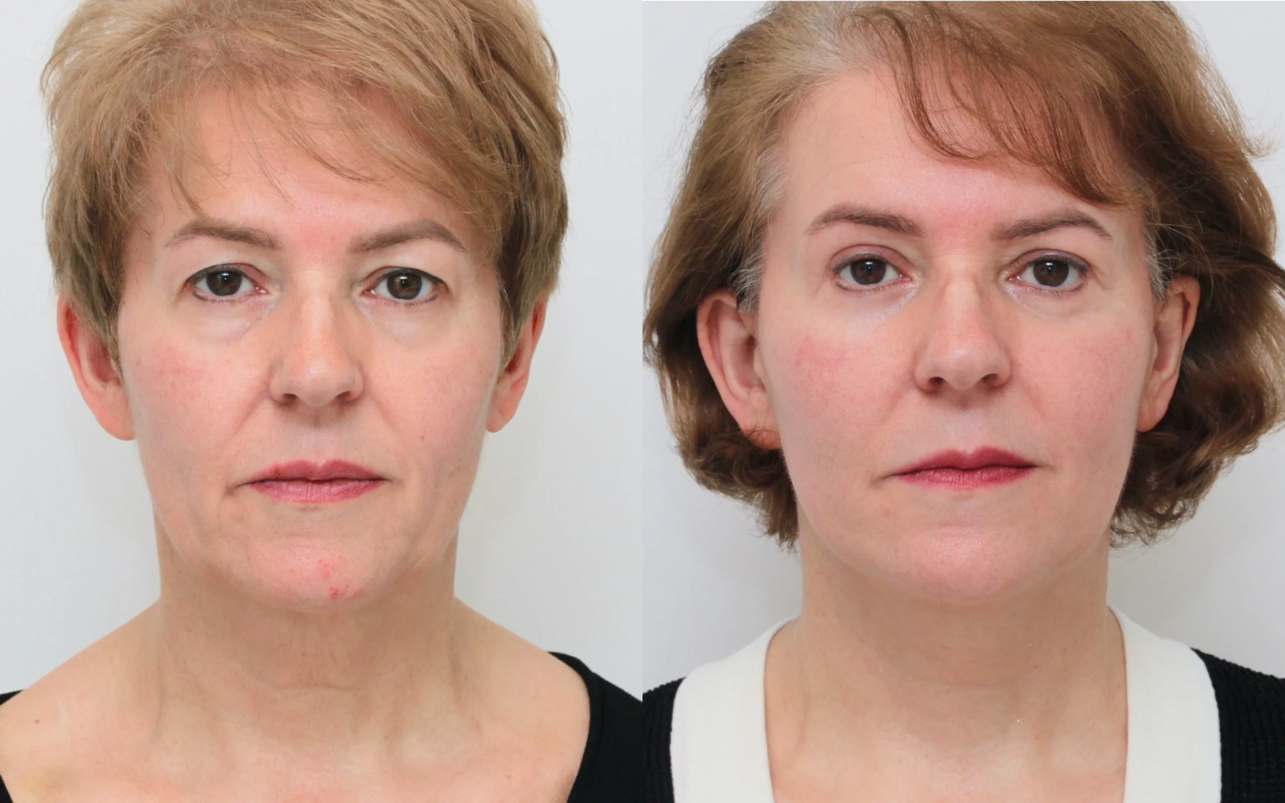 Lower face neck lift and eyelid surgery