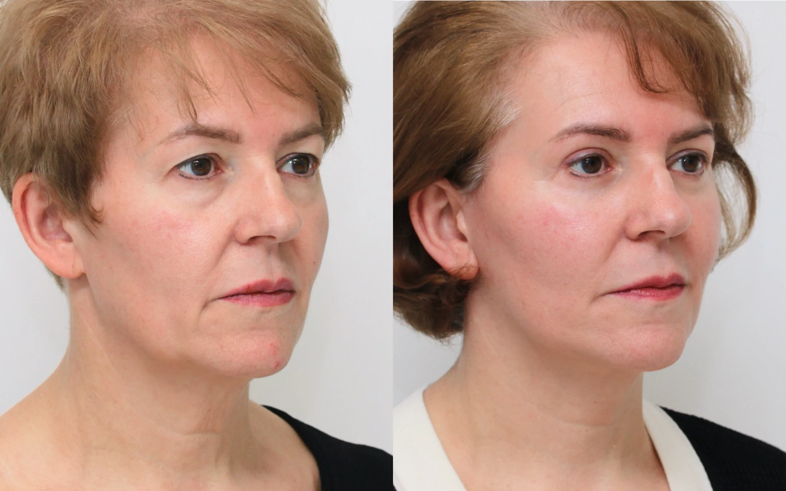 facelift and eyelid surgery