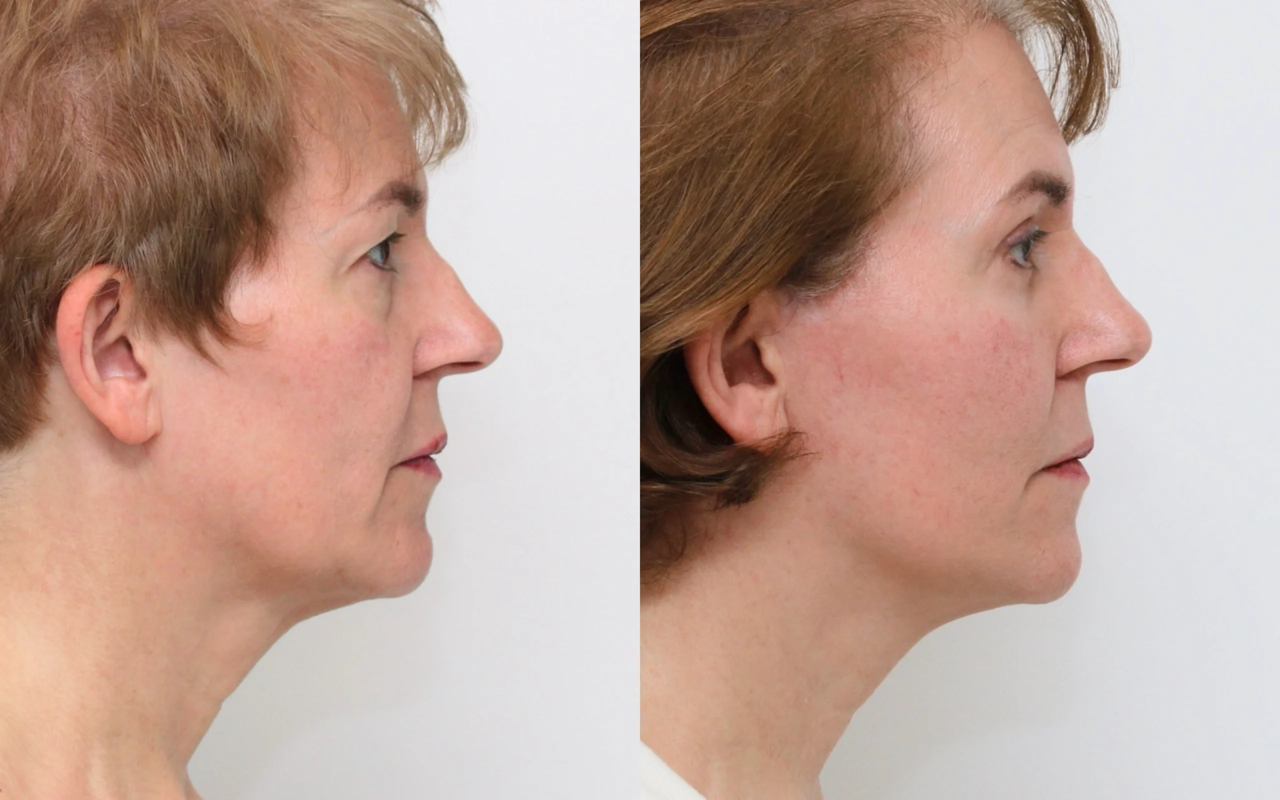 Lower face neck lift and eyelid surgery