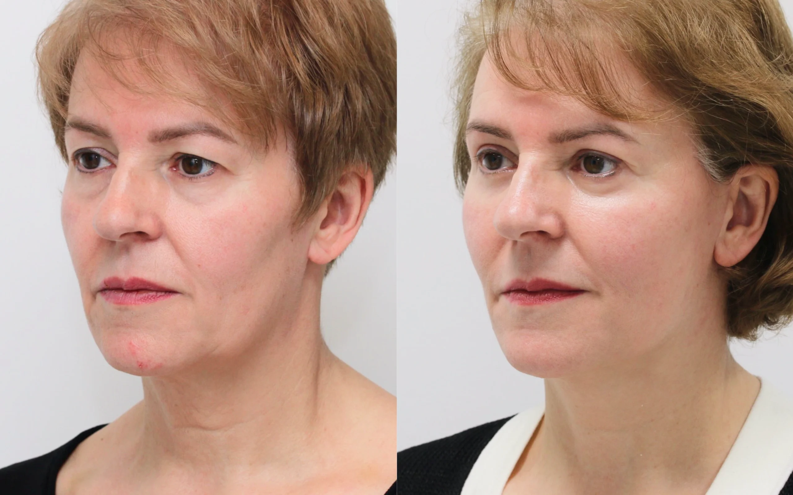 Lower face neck lift and eyelid surgery