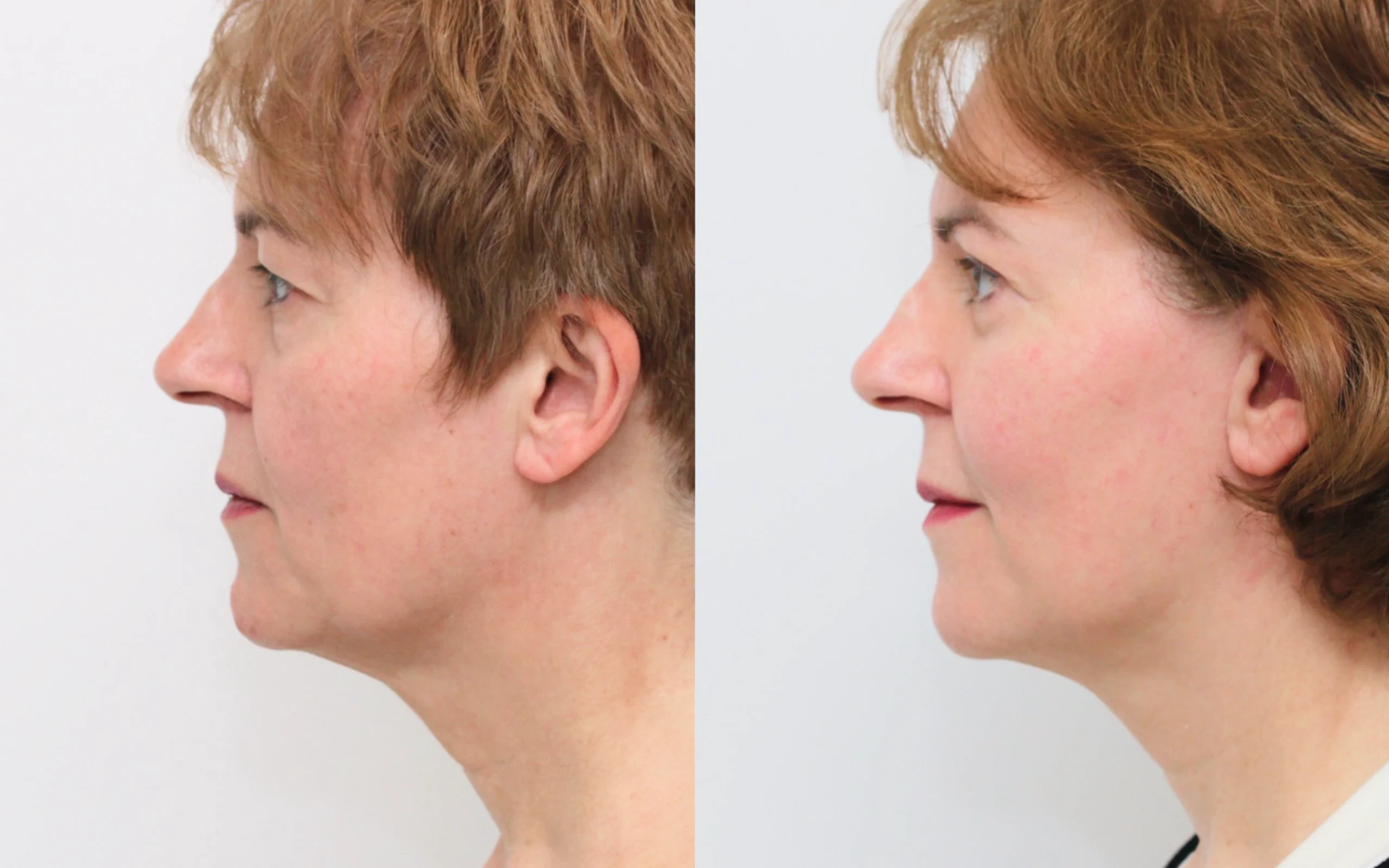 Lower face neck lift and eyelid surgery